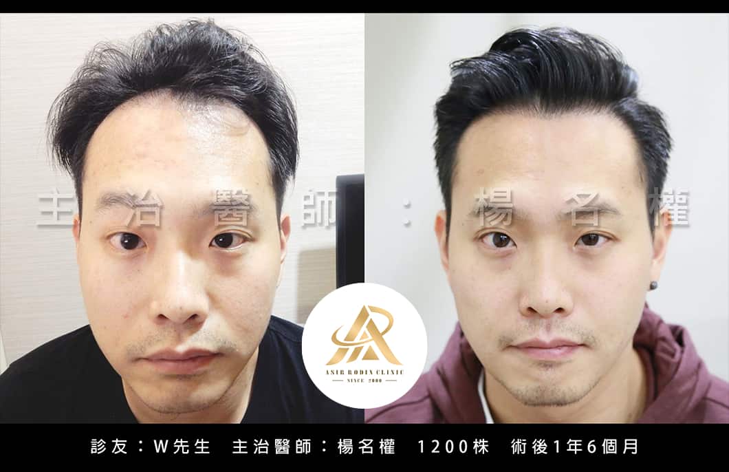 【植髮】楊名權醫師：醫者父母心～